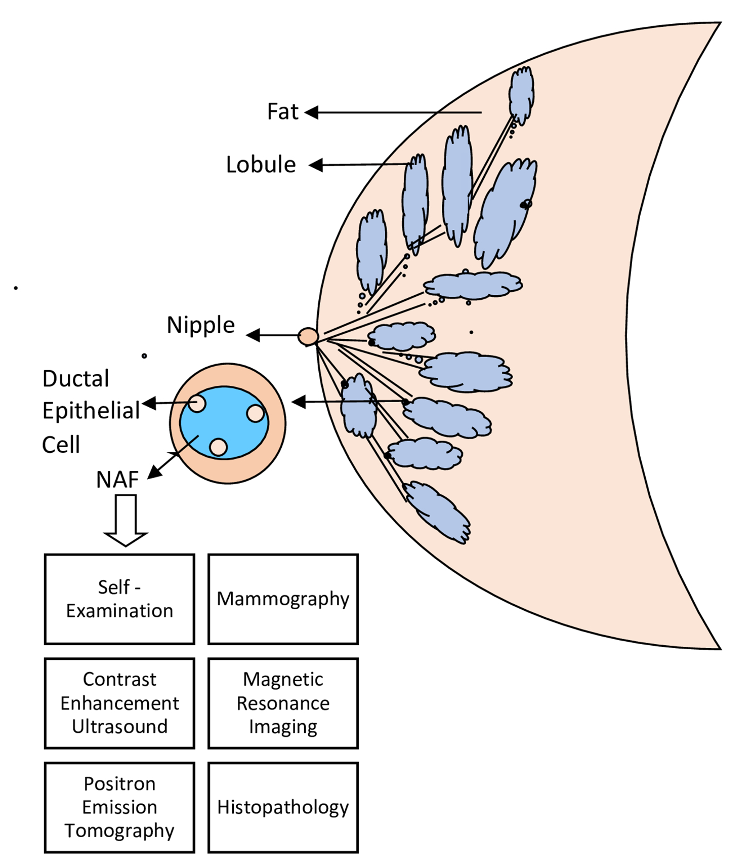 Early detection of breast cancer through the diagnosis of Nipple Aspirate Fluid (NAF)