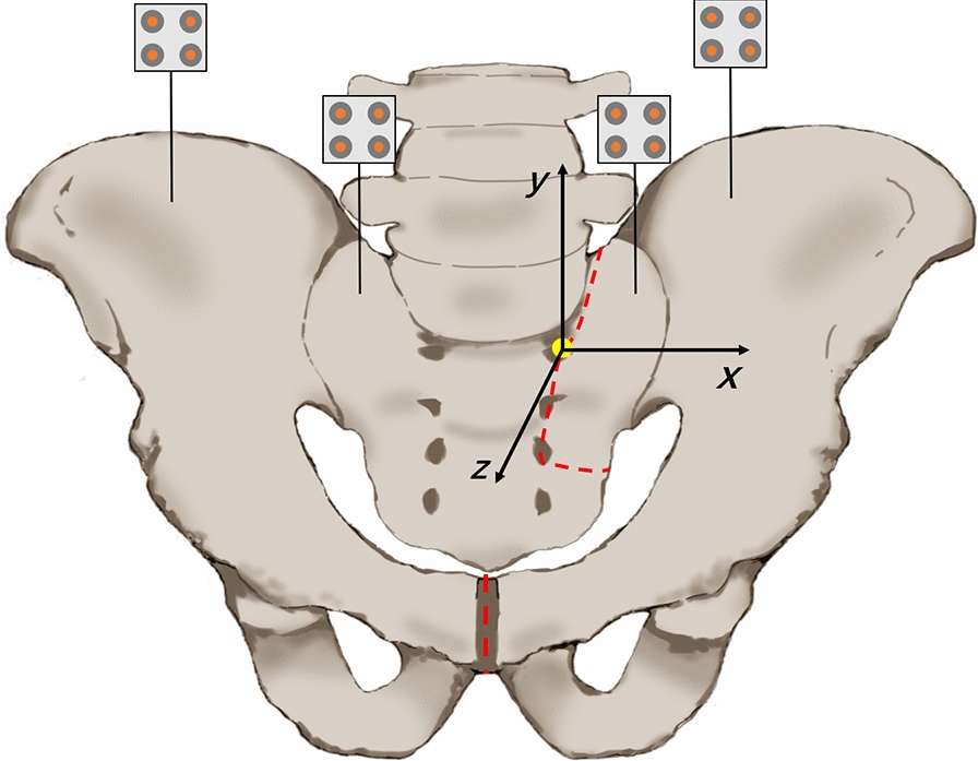 Effect of different lumbar–iliac fixation and sacral slope for Tile C1.3 pelvic fractures: a biomechanical study