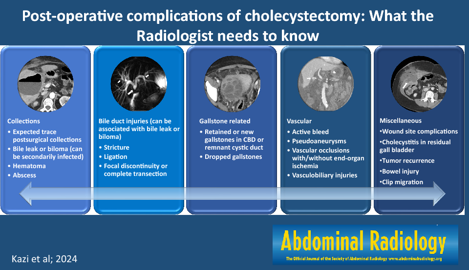 Post-operative complications of cholecystectomy: what the radiologist needs to know