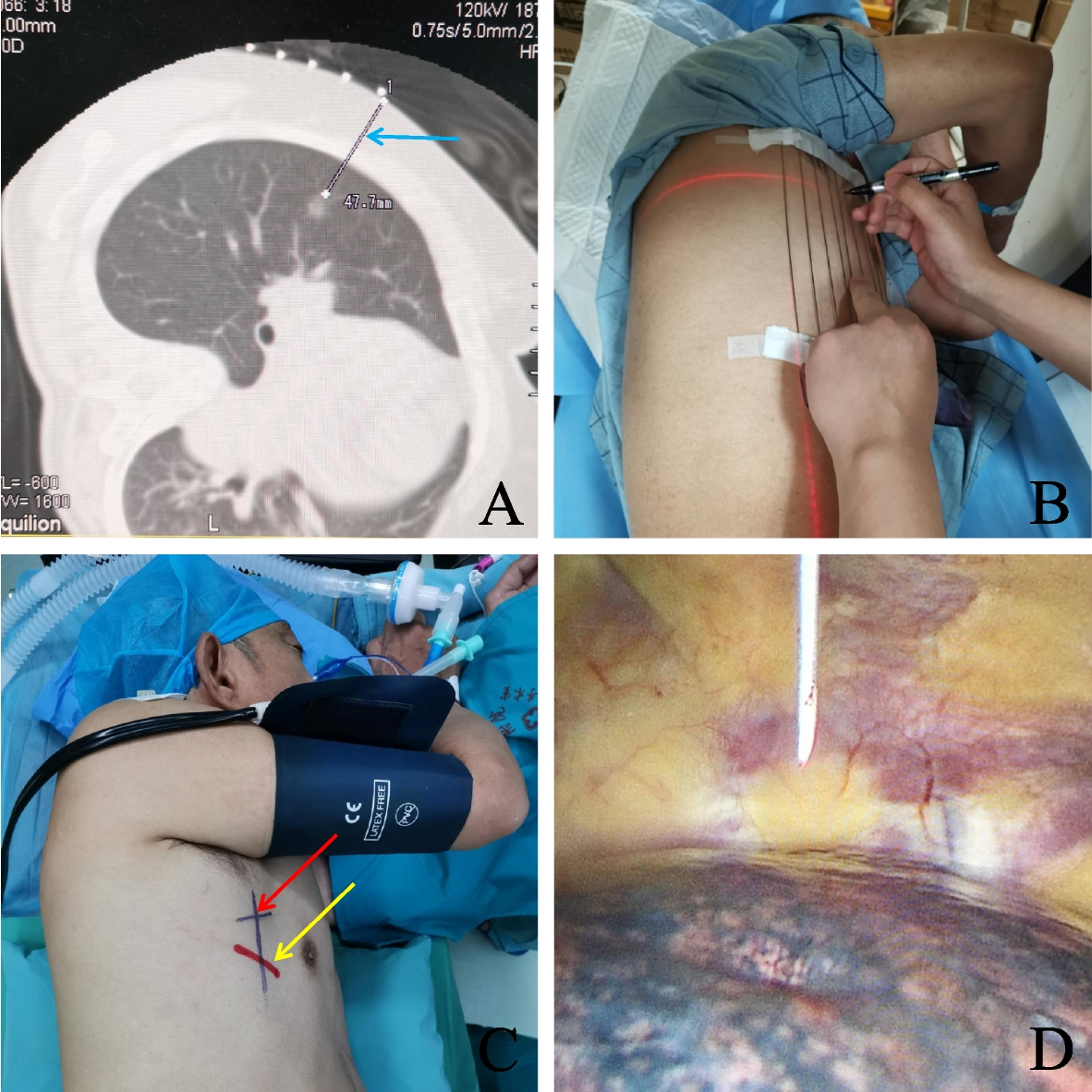 Clinical application of CT-assisted body surface localization combined with intraoperative stereotactic anatomical localization in thoracoscopic lung nodule resection: a single-centre retrospective study
