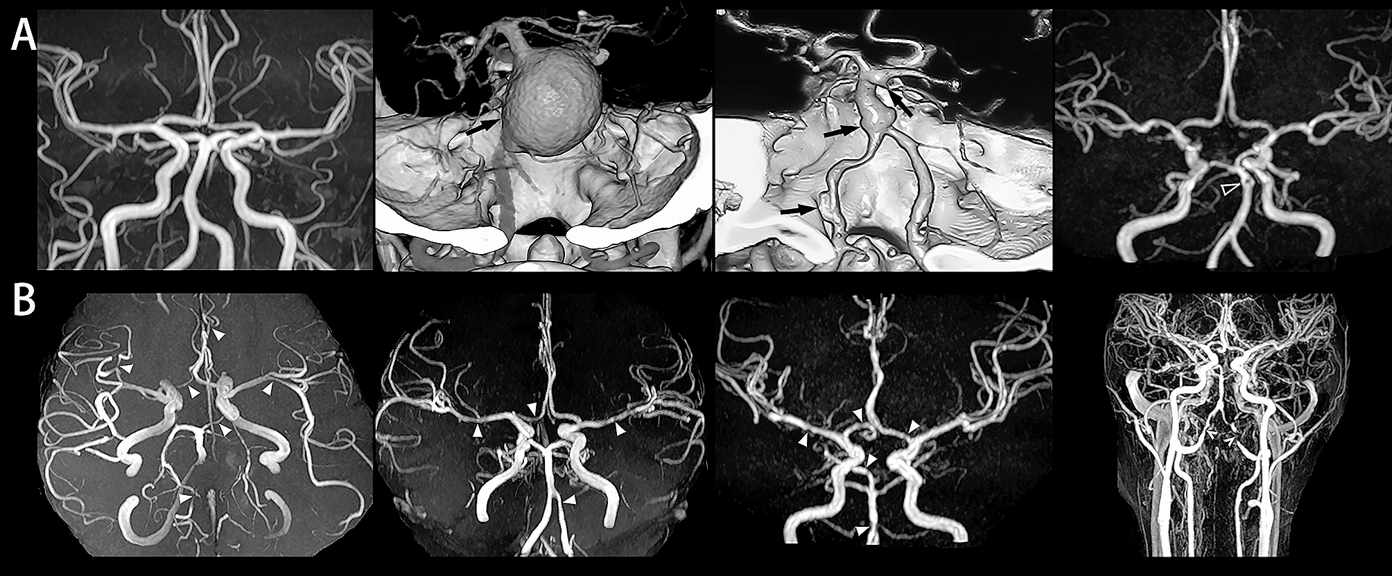 Intracranial vasculopathy: an important organ damage in young adult patients with late-onset Pompe disease