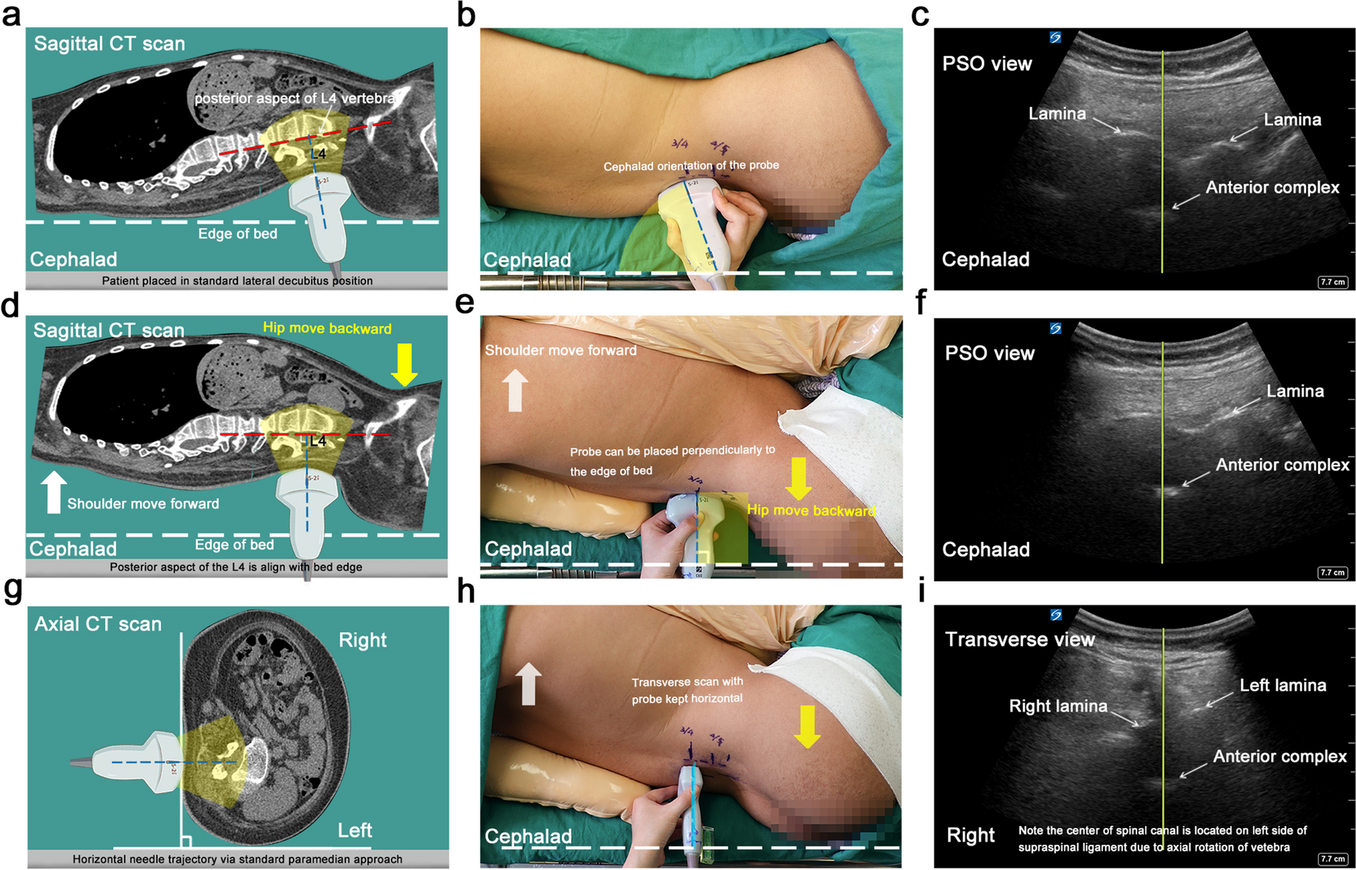 A horizontal and perpendicular interlaminar approach for intrathecal nusinersen injection in patients with spinal muscular atrophy and scoliosis: an observational study