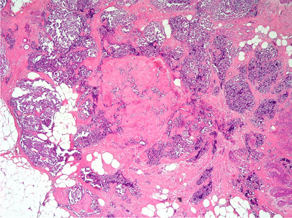 Neuroendocrine neoplasms of the breast: a review of literature