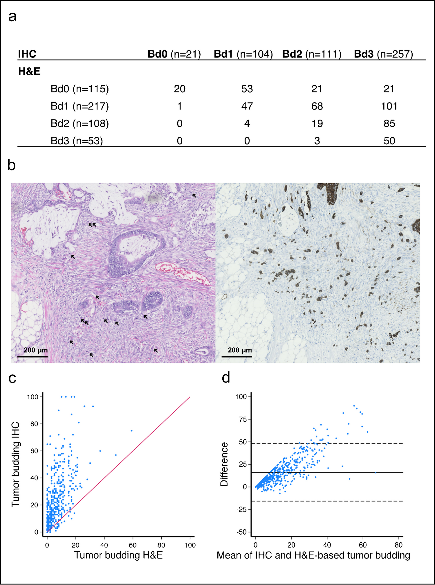 Immunohistochemical analysis of tumor budding in stage II colon cancer: exploring zero budding as a prognostic marker