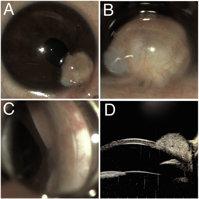 Post-traumatic epicorneal pearl cyst