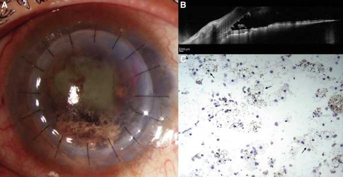 A flocculent iris?