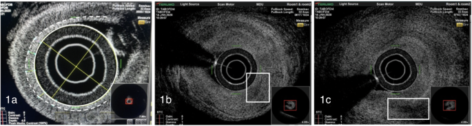 Optical frequency domain imaging (OFDI) represents a novel technique for the diagnosis of giant cell arteritis