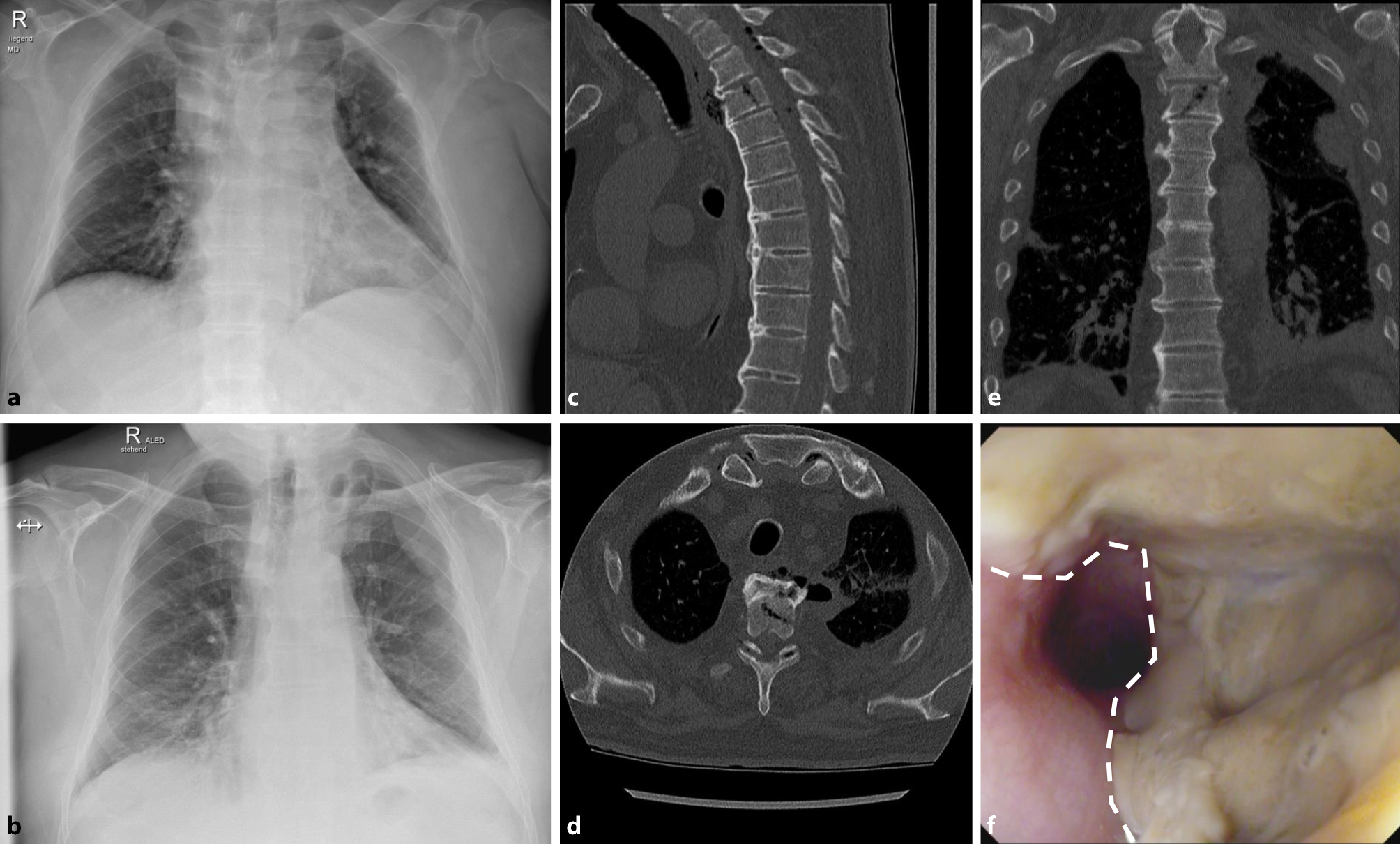 Esophageal perforation with near fatal mediastinitis secondary to Th3 fracture
