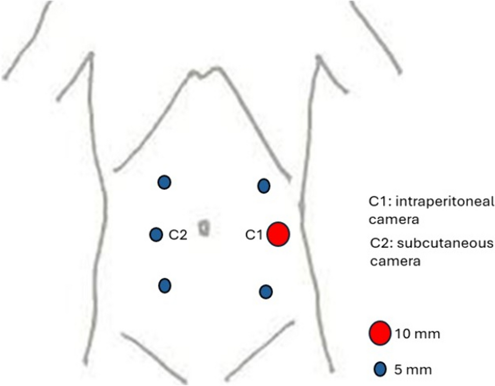 Laparoscopic retromuscular hernia repair (LaHRR): a case-series of 17 patients treated with a novel technique for laparoscopic ventral hernia and diastasis repair