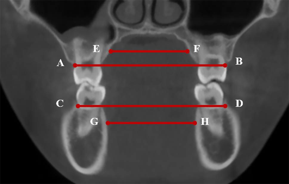 Comparative evaluation of transverse width indices for diagnosing maxillary transverse deficiency