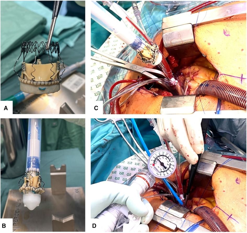 Single-center real-world data and technical considerations from 100 consecutive patients treated with the Perceval aortic bioprosthesis