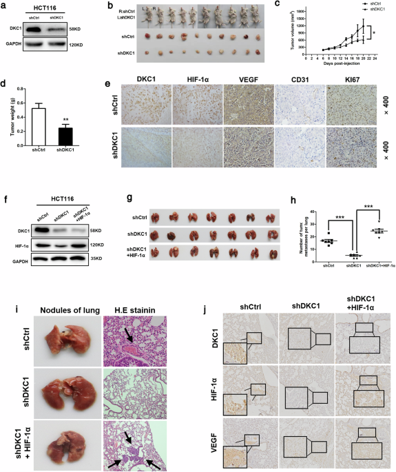 Correction: DKC1 enhances angiogenesis by promoting HIF-1α transcription and facilitates metastasis in colorectal cancer