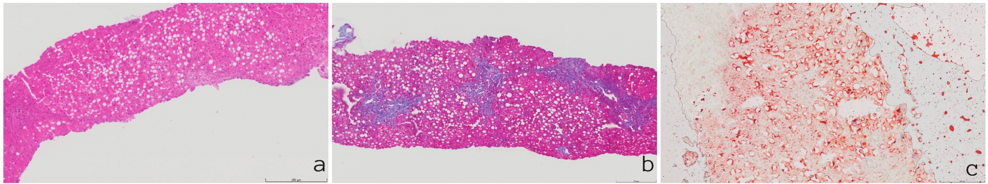 Membranoproliferative glomerulonephritis in a patient with lysinuric protein intolerance: lesson for the clinical nephrologist