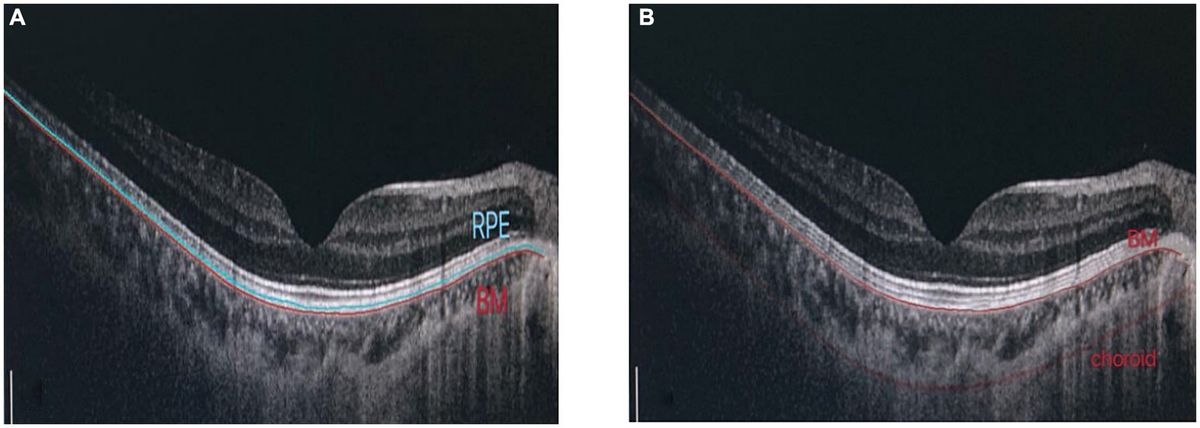 Structural, blood flow and functional changes in the macular area and the expression of aqueous humor factors in myopia