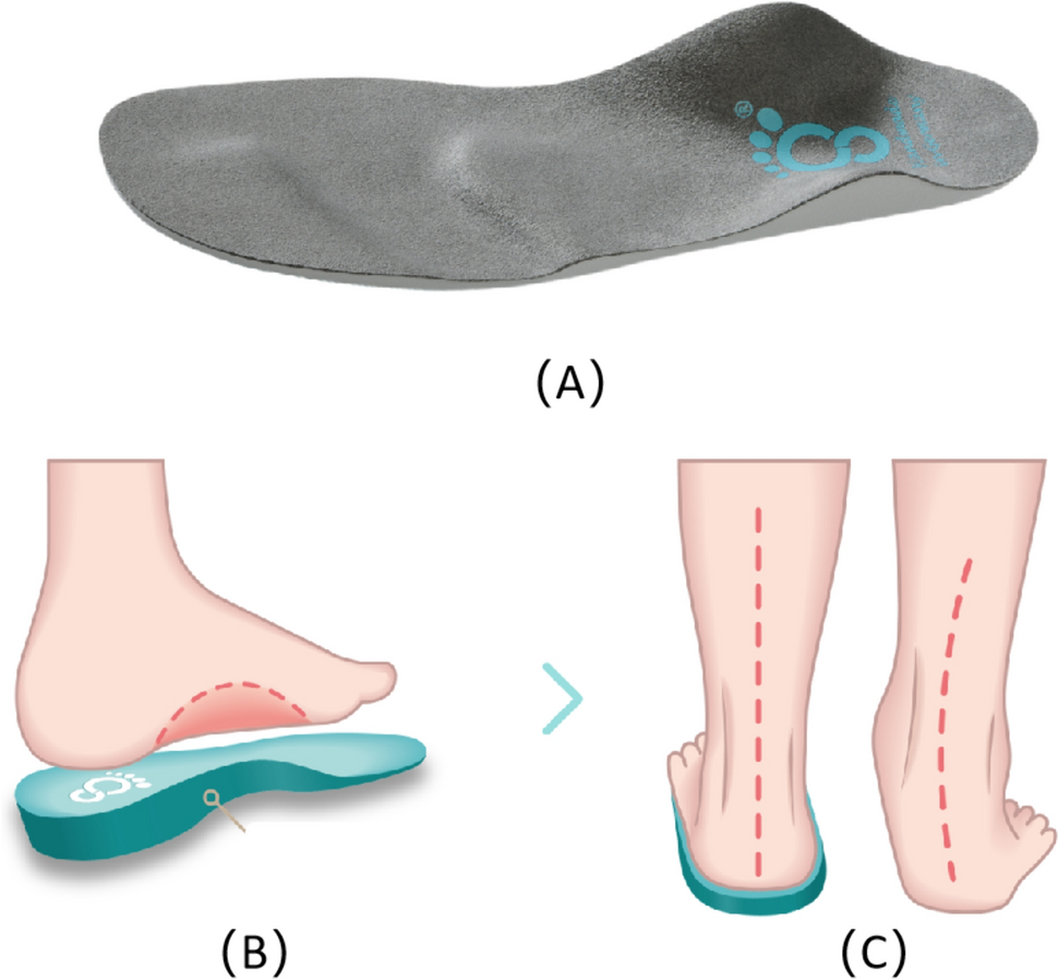 Four-Year Treatment Effect of Custom-Made Foot Orthosis on Pediatric Symptomatic Accessory Navicular Bone Combined with Flexible Flatfoot