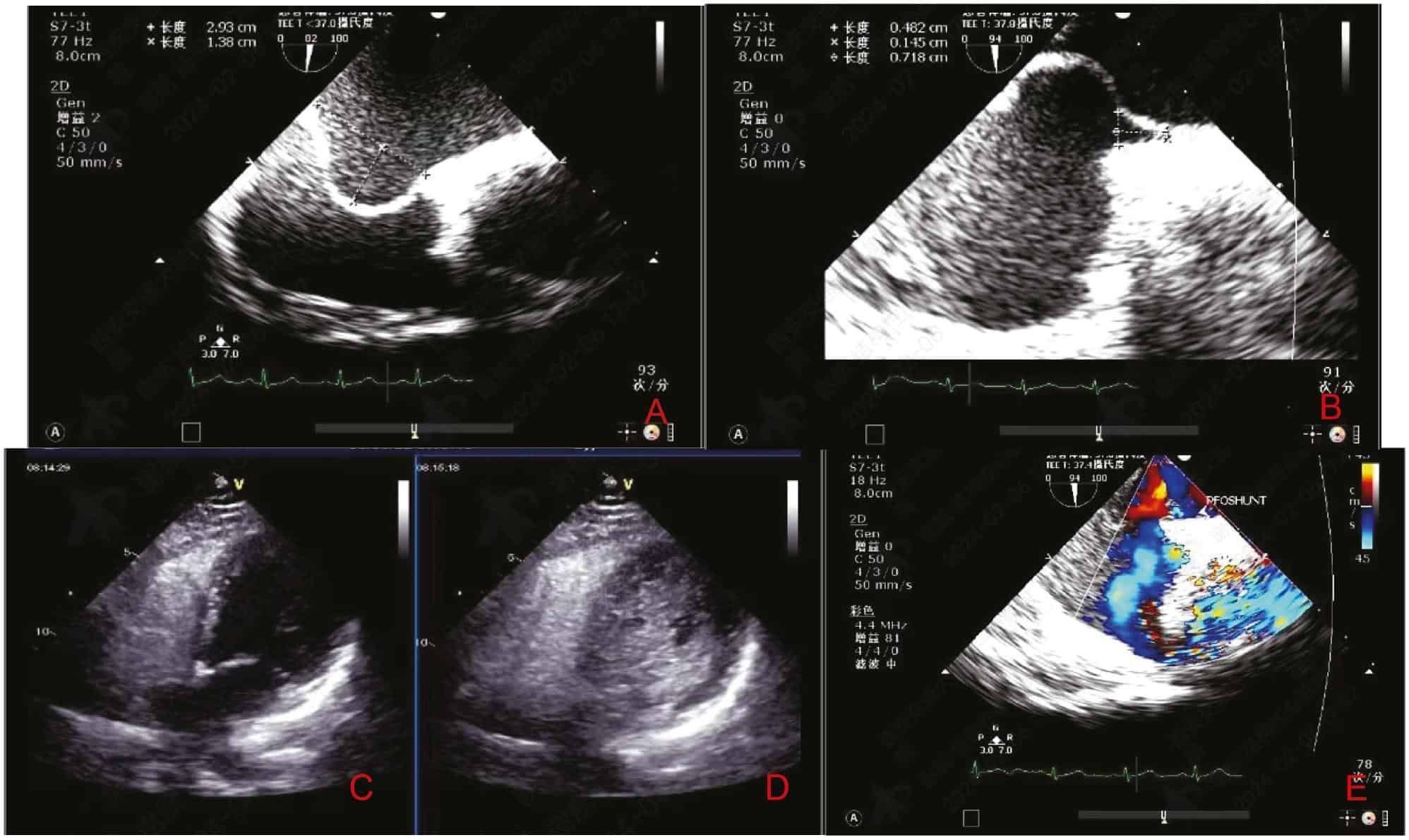 Clinical Implications and Procedural Complications in Patients with Patent Foramen Ovale Concomitant with Atrial Septal Aneurysm
