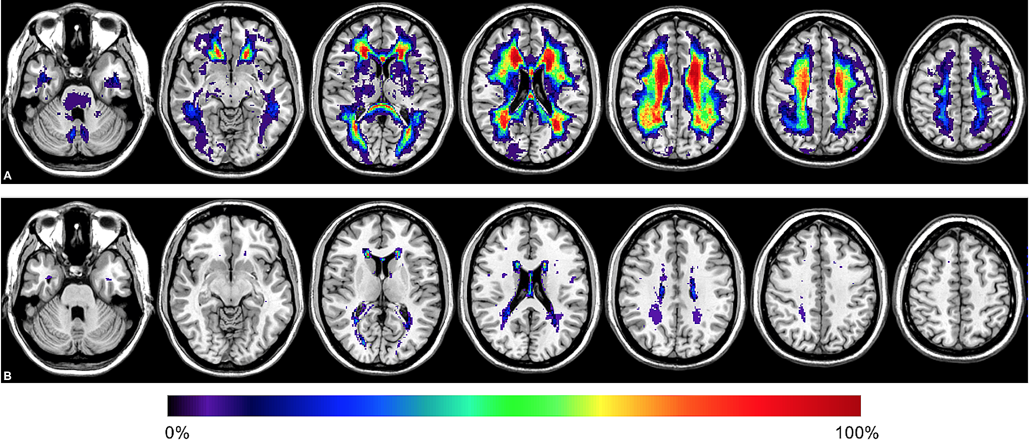 Mapping macrostructural and microstructural brain alterations in patients with neuronal intranuclear inclusion disease