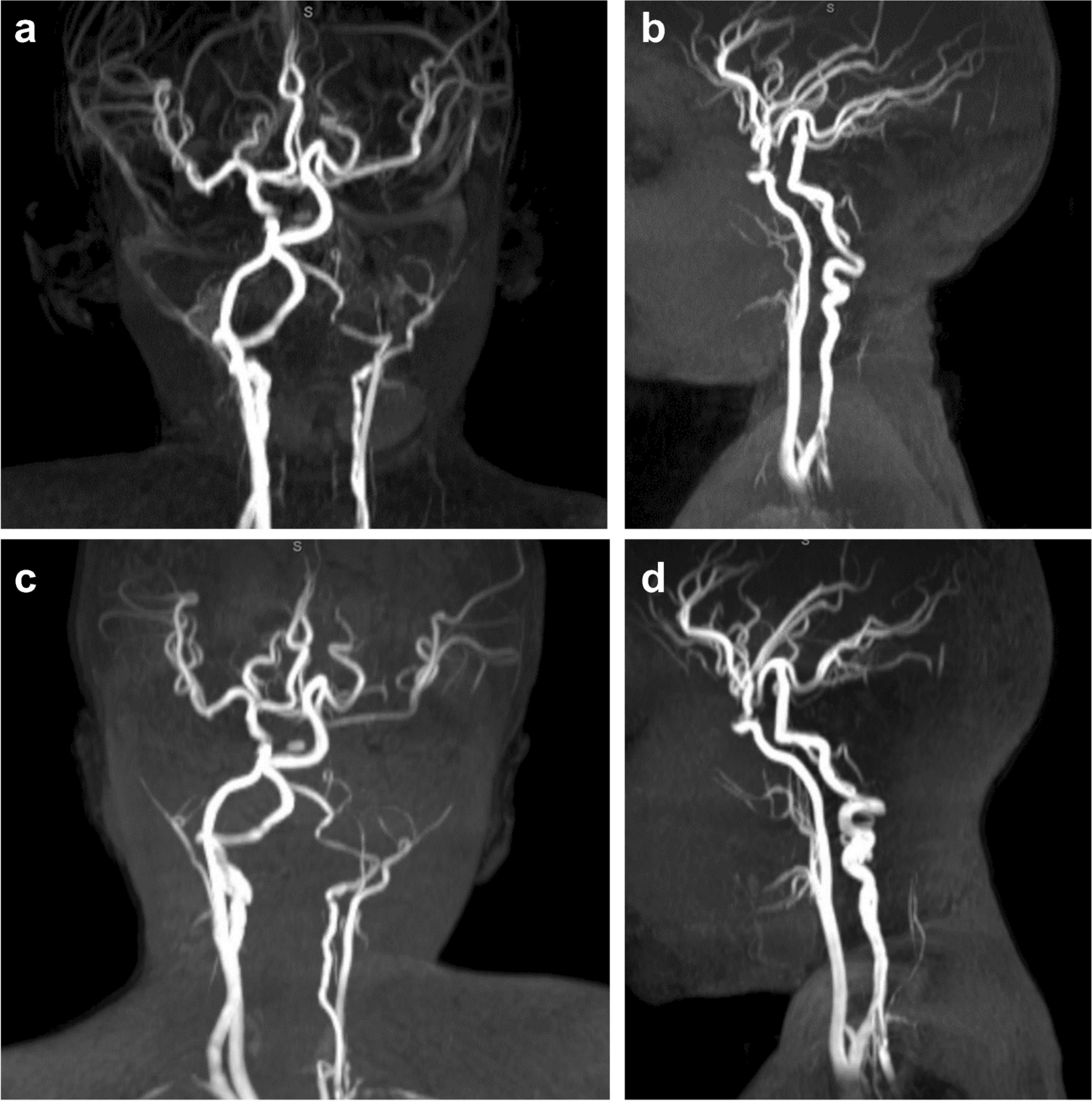 Evolution of cerebrovascular imaging and associated clinical findings in children with Alagille syndrome