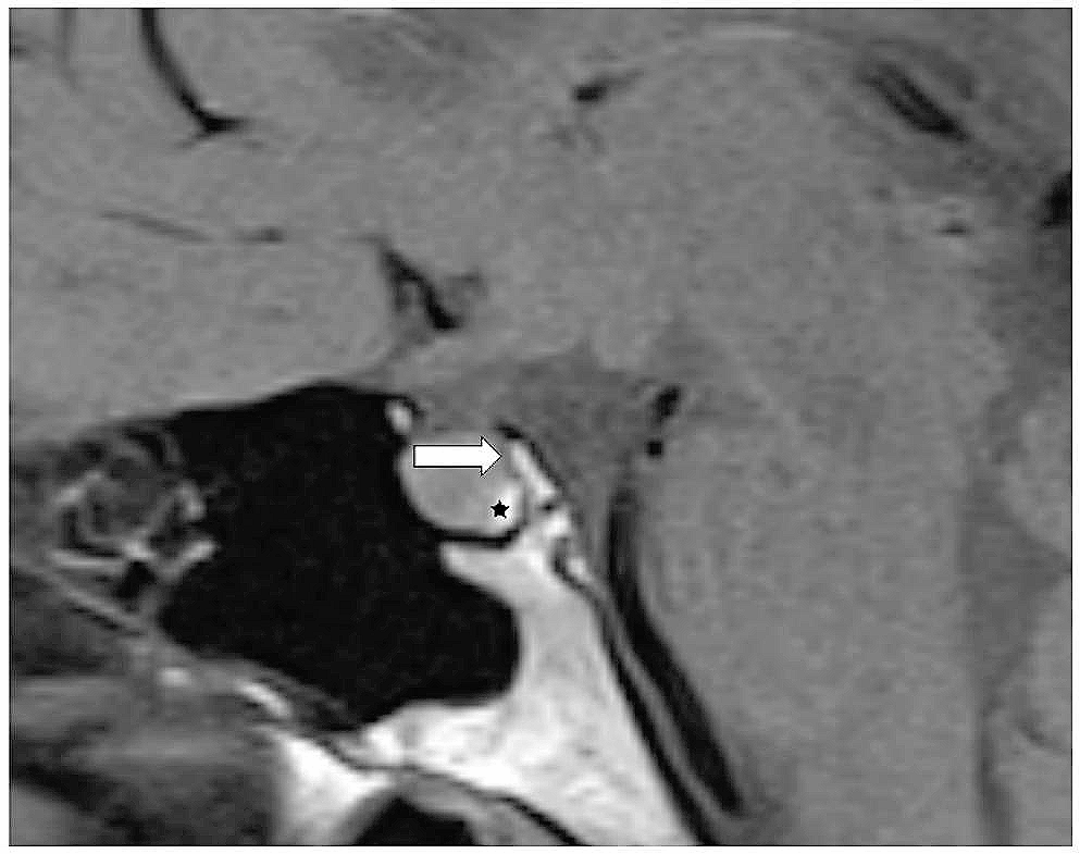 Imaging in malignant germ cell tumors involving the hypothalamo-neurohypophyseal axis: the evaluation of the posterior pituitary bright spot is essential