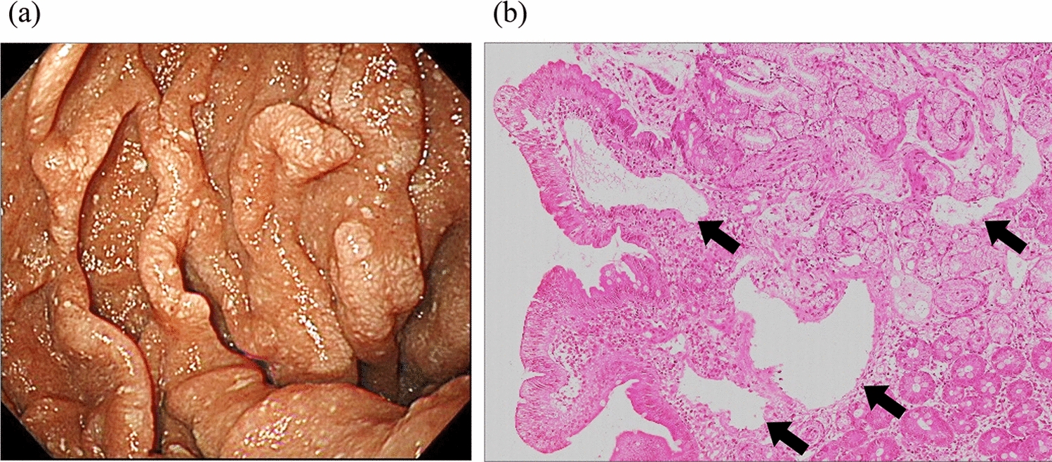 First case report of intestinal lymphangiectasia with refractory bleeding from the duodenum, successfully treated by intra-abdominal lymphaticovenous anastomosis with venous ligation