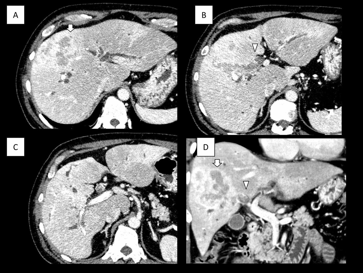 Successful intrahepatic cholangiocarcinoma conversion surgery after administration of fibroblast growth factor receptor inhibitor