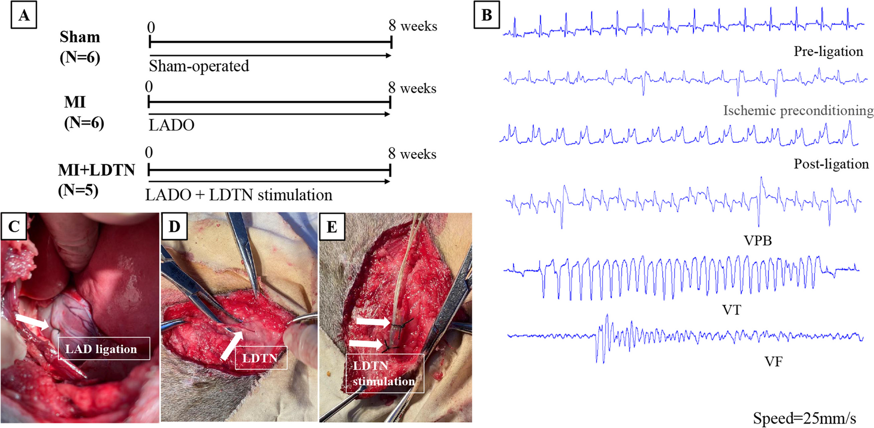 Long-Term Stimulation of the Left Dorsal Branch of the Thoracic Nerve Improves Ventricular Electrical Remodeling in a Canine Model of Chronic Myocardial Infarction