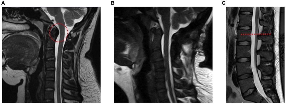 Co-occurrence of tethered cord syndrome and cervical spine instability in hypermobile Ehlers-Danlos syndrome