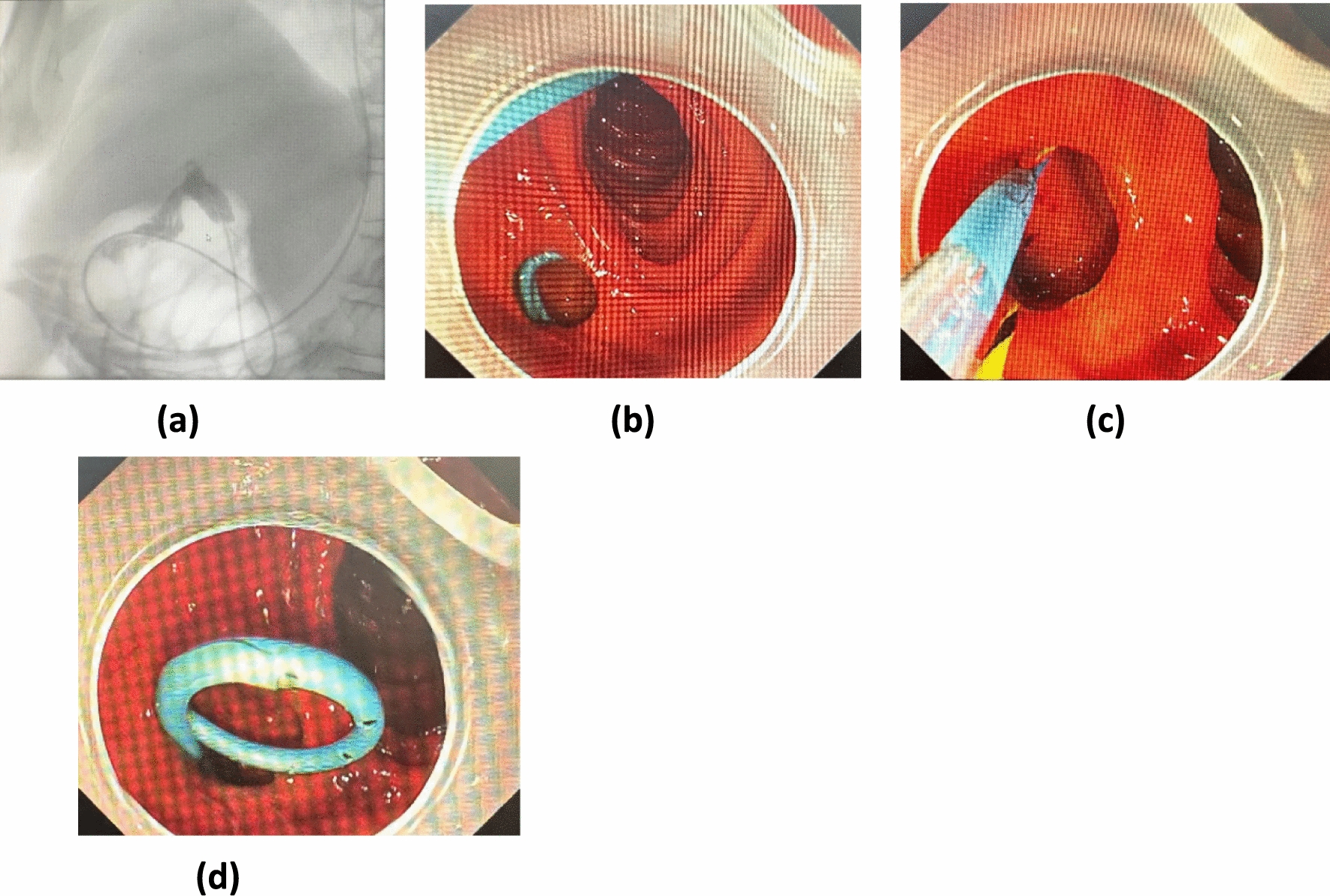 Endoscopic Placement of a Stent for Proximal Biliary Obstruction Due to a Choledochoduodenal Fistula