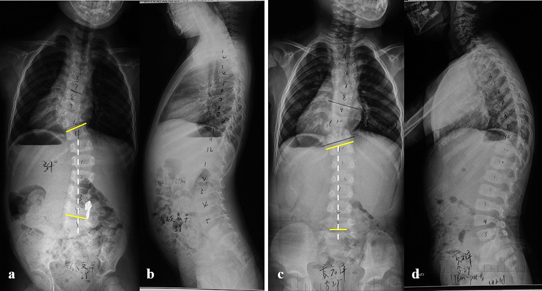Presence of compensatory curve predicts postoperative curve progression in congenital scoliosis after thoracolumbar hemivertebra resection and short fusion