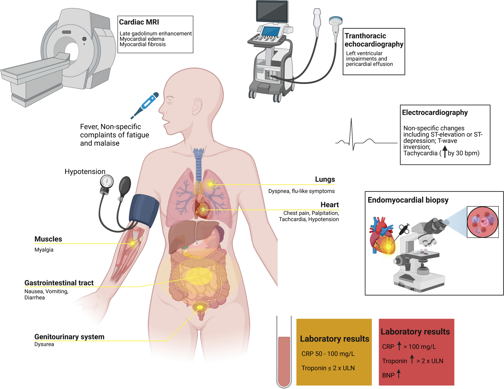 When, Why and How to Re-challenge Clozapine in Schizophrenia Following Myocarditis