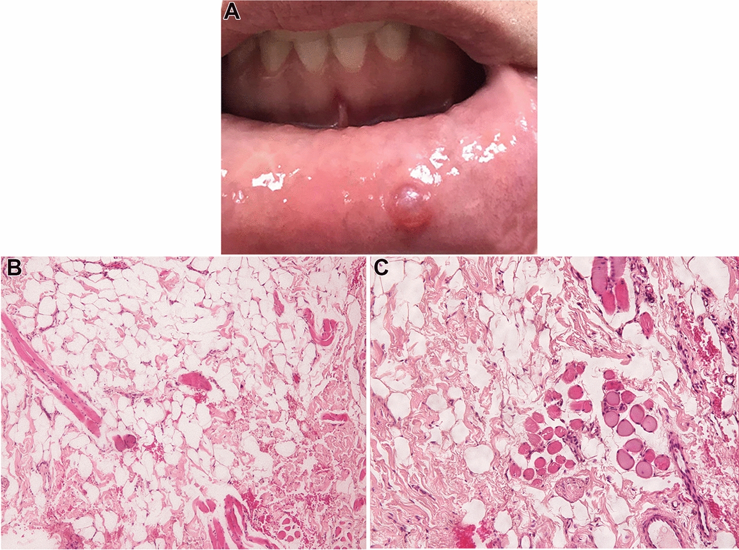 Oral Intramuscular Lipoma with Unusual Clinical Presentation: Differential Diagnosis and Review of the Literature