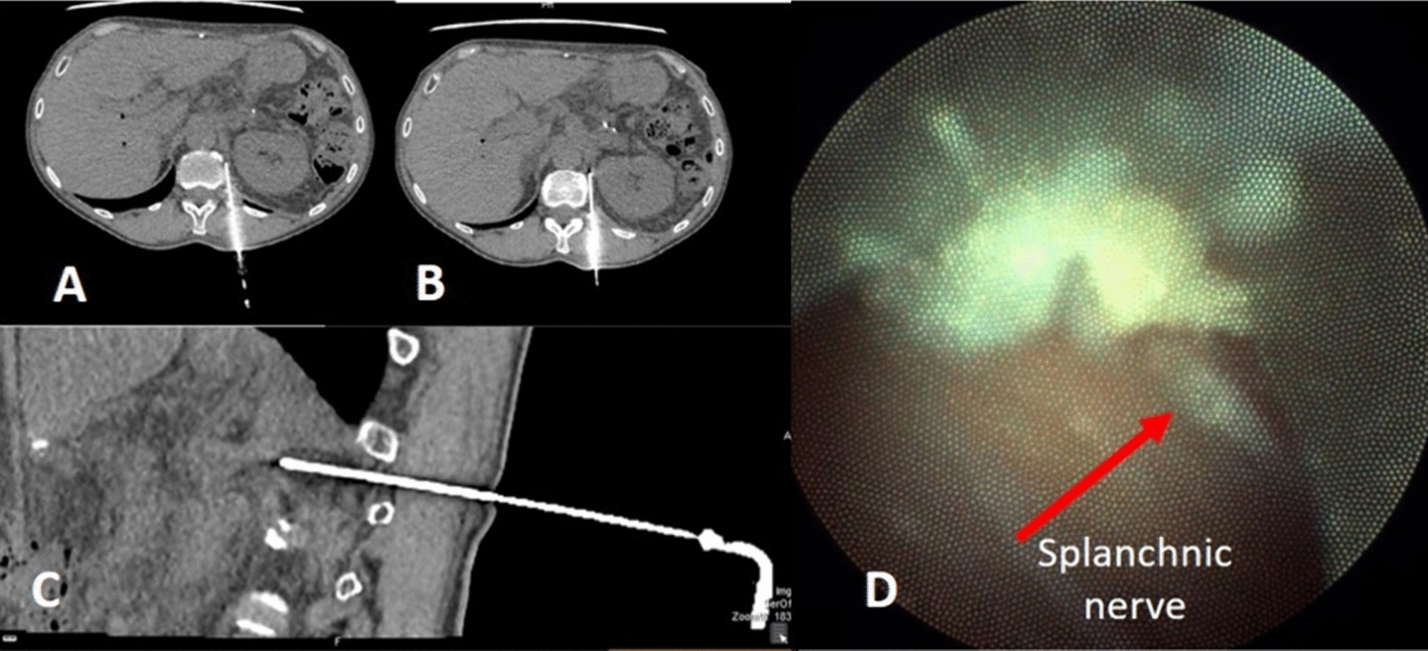 Percutaneous Cryoneurolysis of Splanchnic Nerves Under Combined Computed Tomography and Endoscopy Guidance: Pushing the Boundaries of Hybrid Imaging