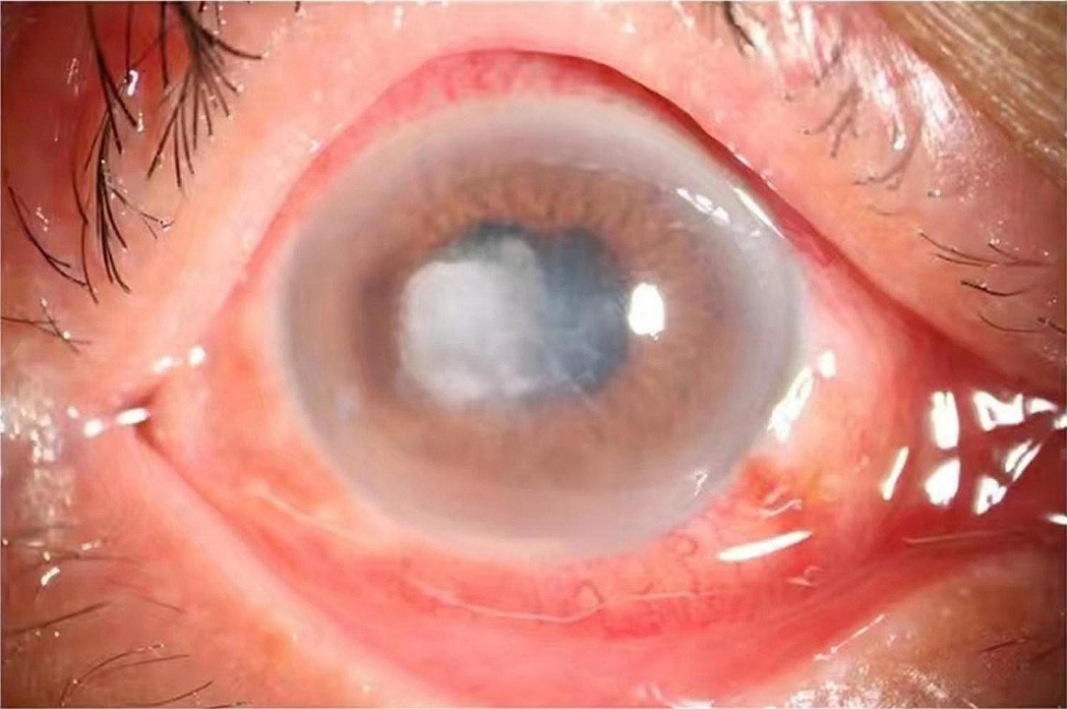 Pseudonectria keratitis—emerging pathogenic fungi in the eye
