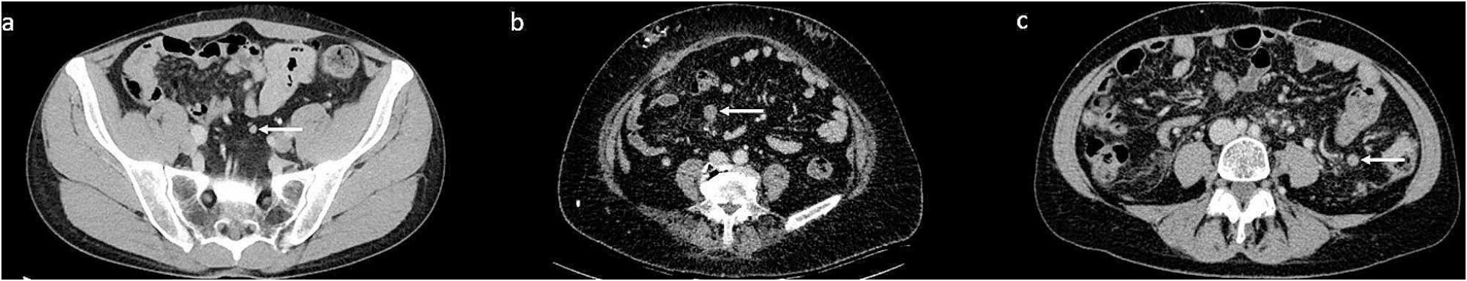 Diagnostic accuracy and reliability of CT-based Node-RADS for colon cancer