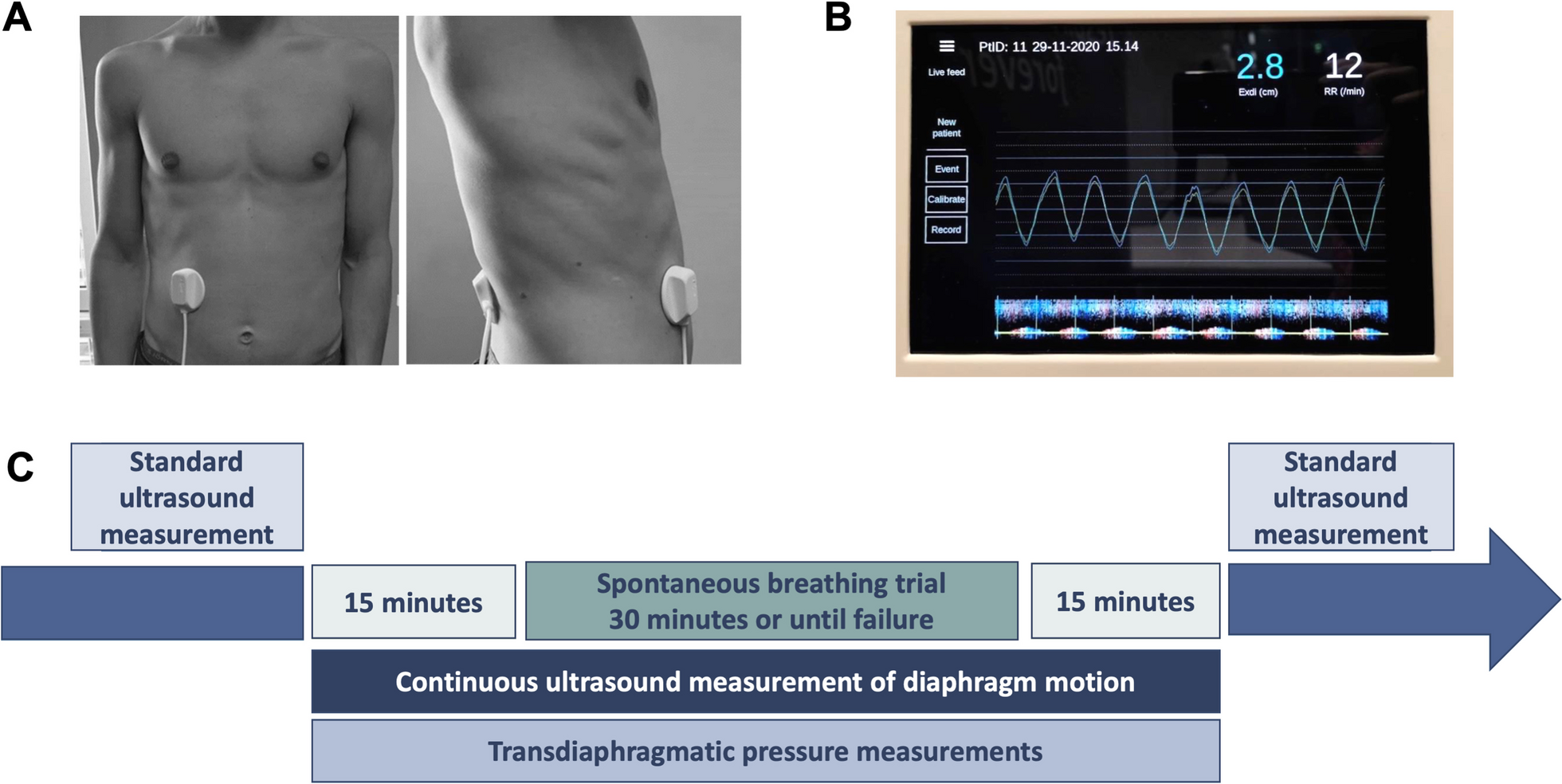 Operator independent continuous ultrasound monitoring of diaphragm excursion predicts successful weaning from mechanical ventilation: a prospective observational study