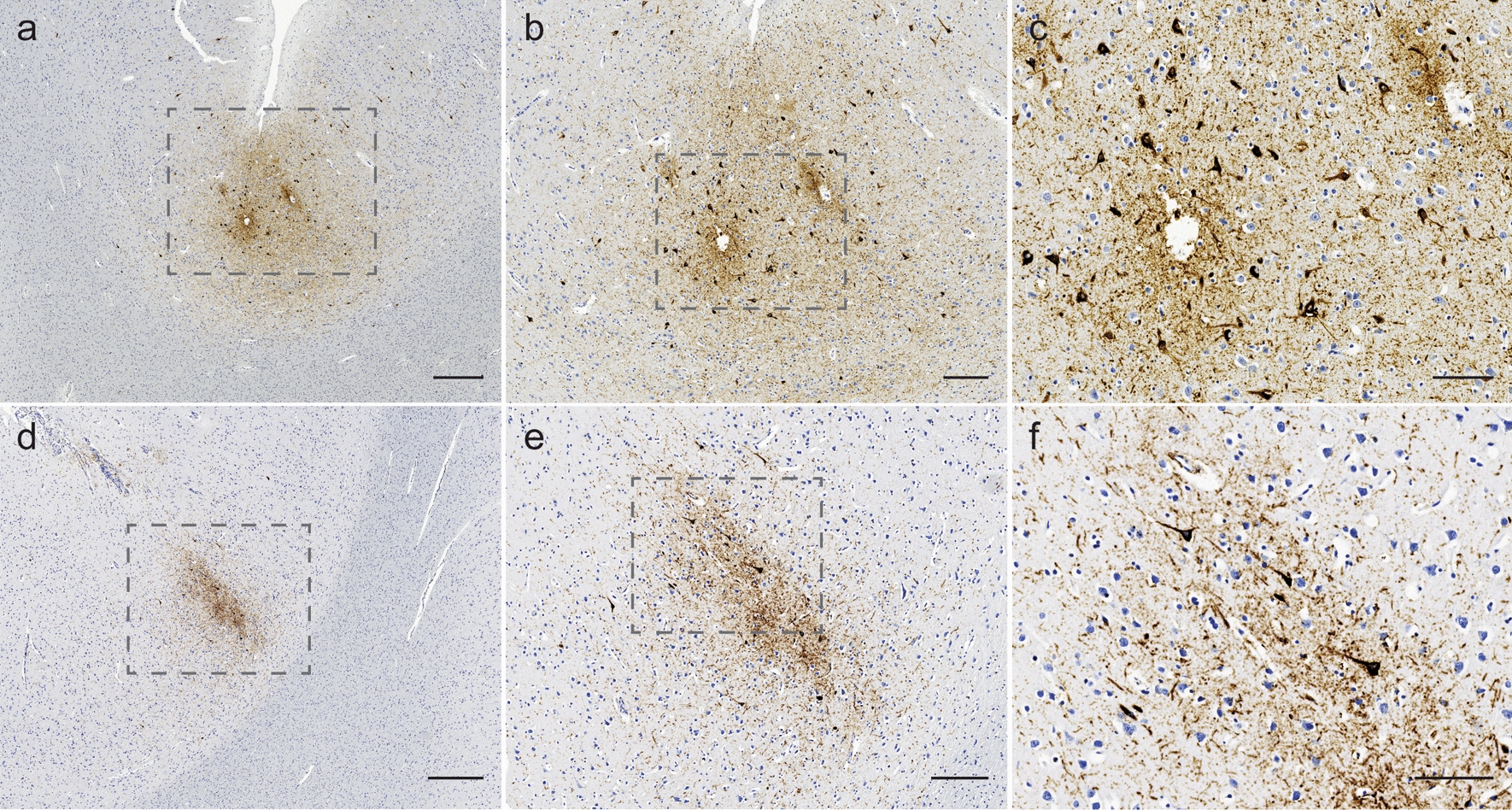 Chronic traumatic encephalopathy (CTE) in the context of longstanding intimate partner violence