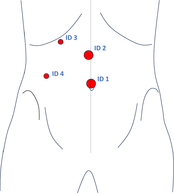 Extra-abdominal trocar and instrument detection for enhanced surgical workflow understanding