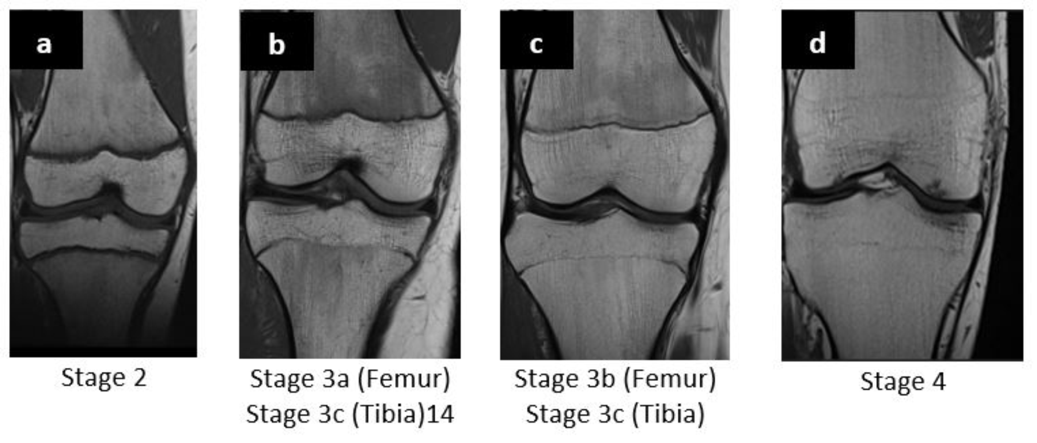Forensic age estimation by MRI of the knee – comparison of two classifications for ossification stages in a German population