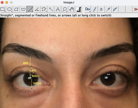 Evaluation of eyelid features’ changes before and after COVID-19 pandemic amongst healthcare and home office workers