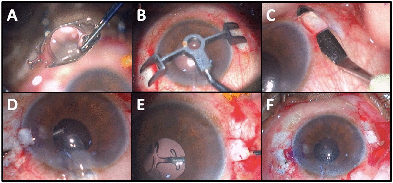 Long term surgical results and safety profile of the novel CM T Flex scleral fixated intraocular lens