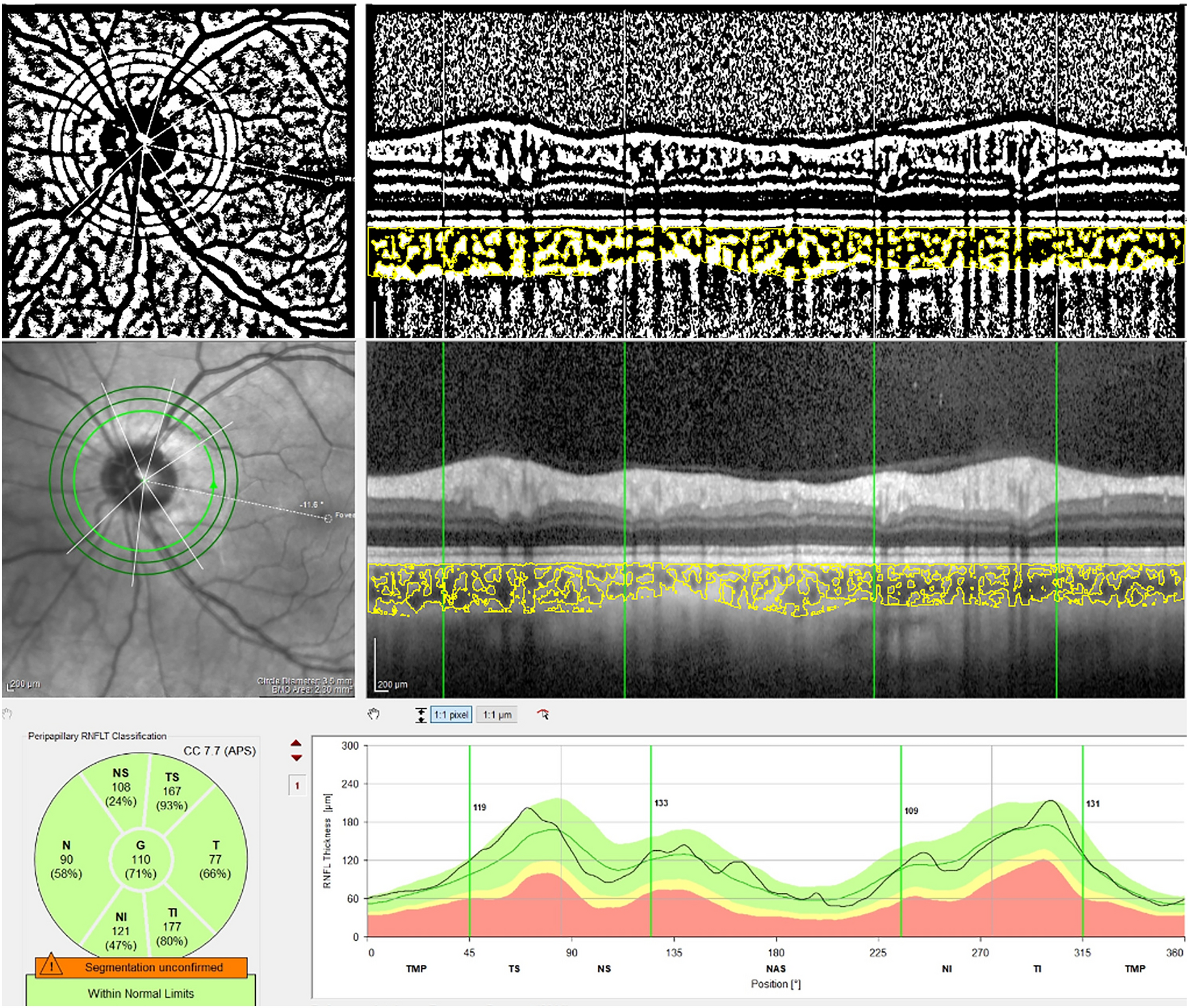 Vascular changes of the peripapillary choroidal area in the thyroid orbitopathy