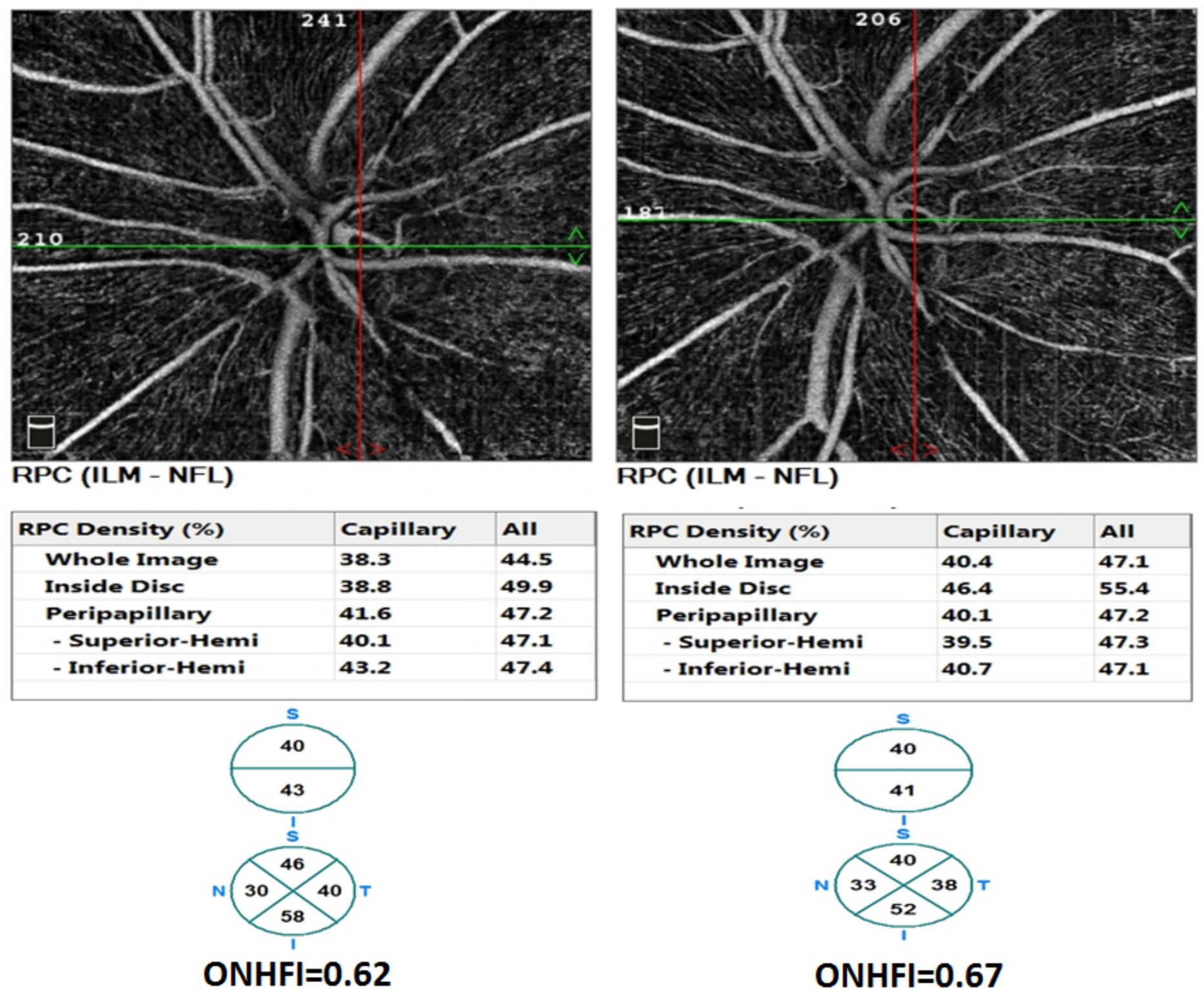 Effect of brimonidine on vascular density and imagej-derived flow index of optic nerve head and macula in primary open angle glaucoma