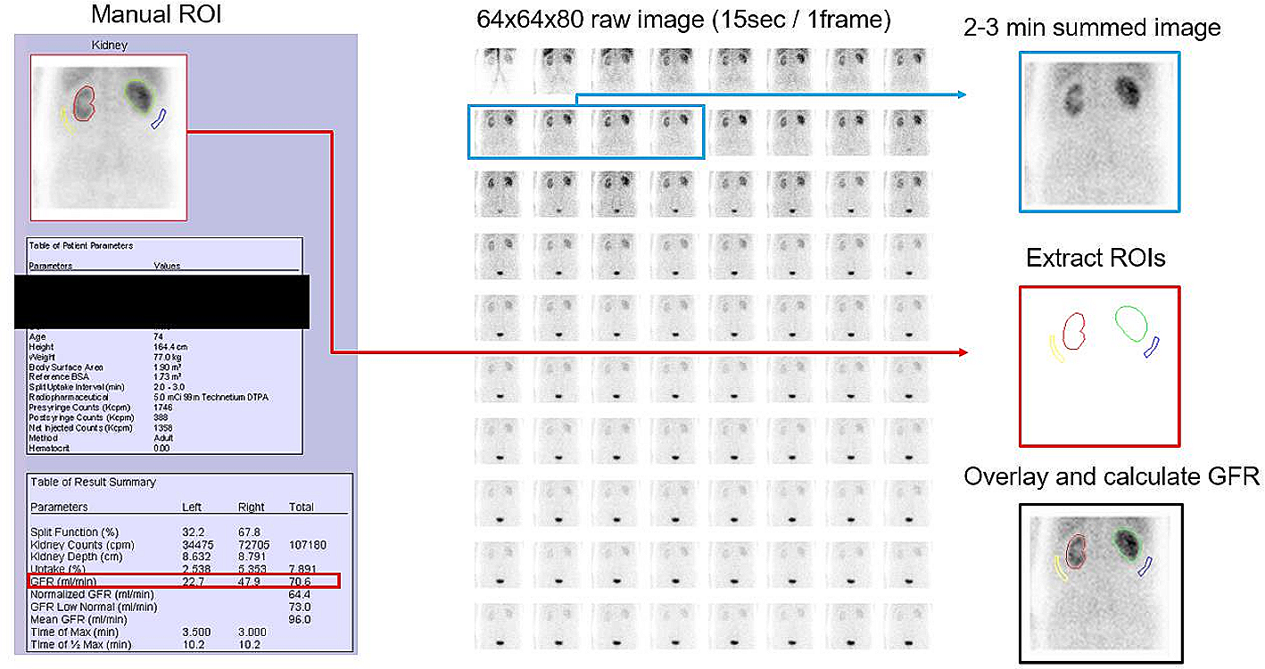 Deep learning-based measurement of split glomerular filtration rate with 99mTc-diethylenetriamine pentaacetic acid renal scan