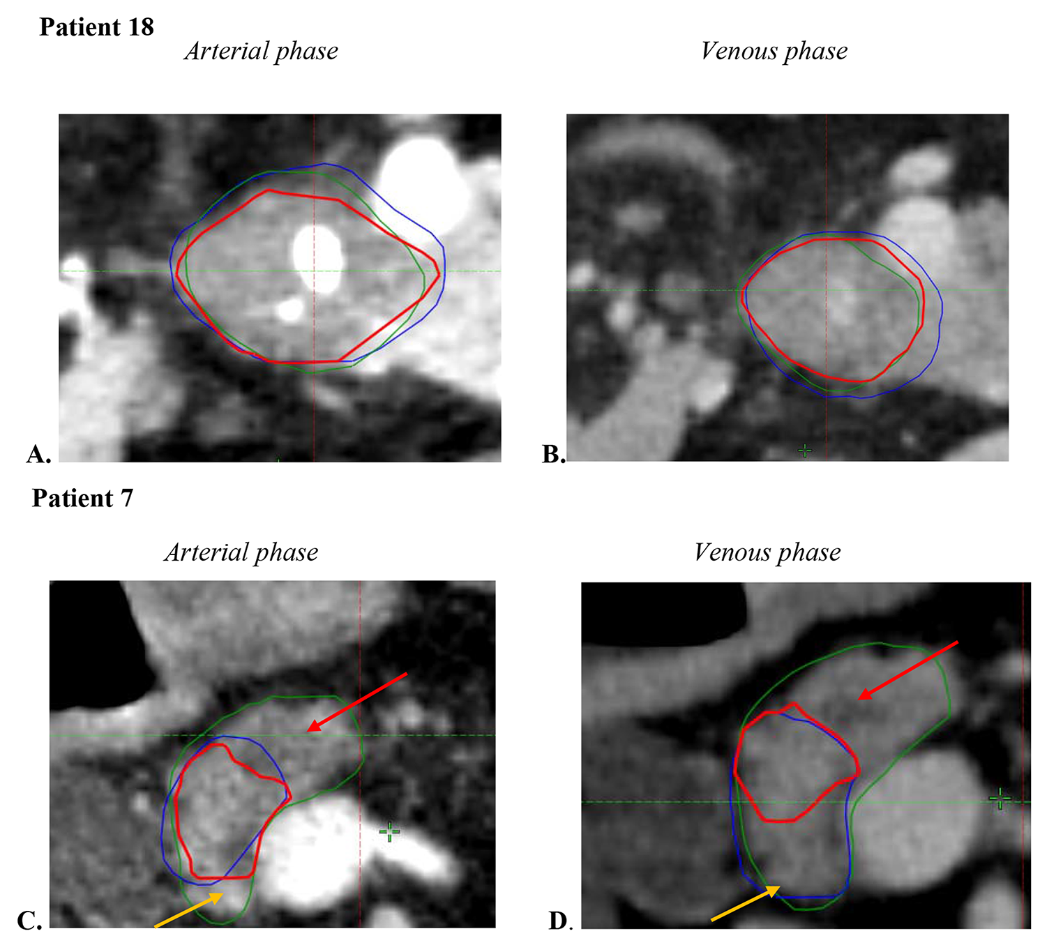 A comparison of target volumes drawn on arterial and venous phase scans during radiation therapy planning for patients with pancreatic cancer: the PANCRINJ study