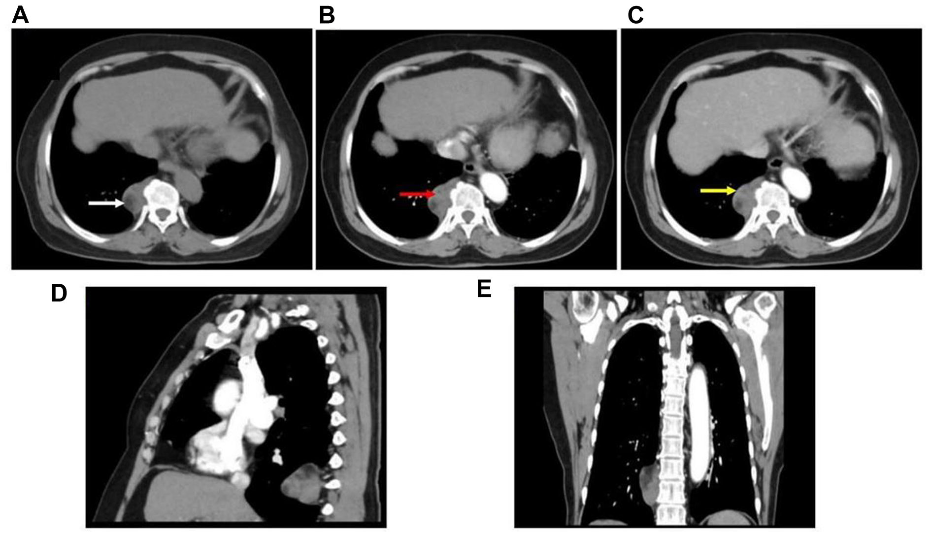 A case of posterior mediastinal myelolipoma and a literature review of its imaging manifestations