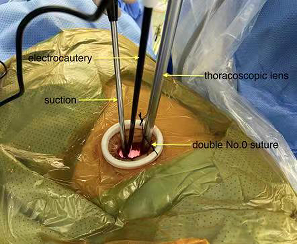 Safety of one 8.5-Fr pigtail catheter for postoperative continuous open gravity drainage after uniportal video-assisted thoracoscopic surgery pneumonectomy