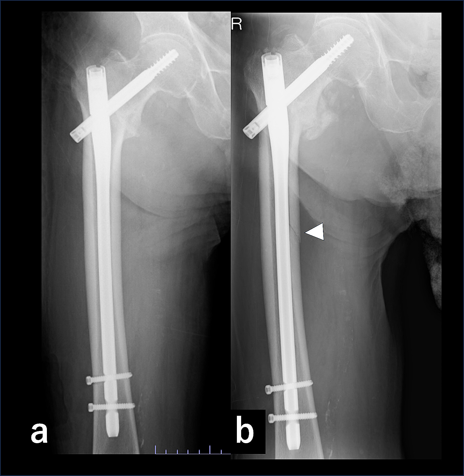 Peri-implant fractures after Intramedullary fixation for femoral trochanteric fracture: a multicenter (TRON Group) study