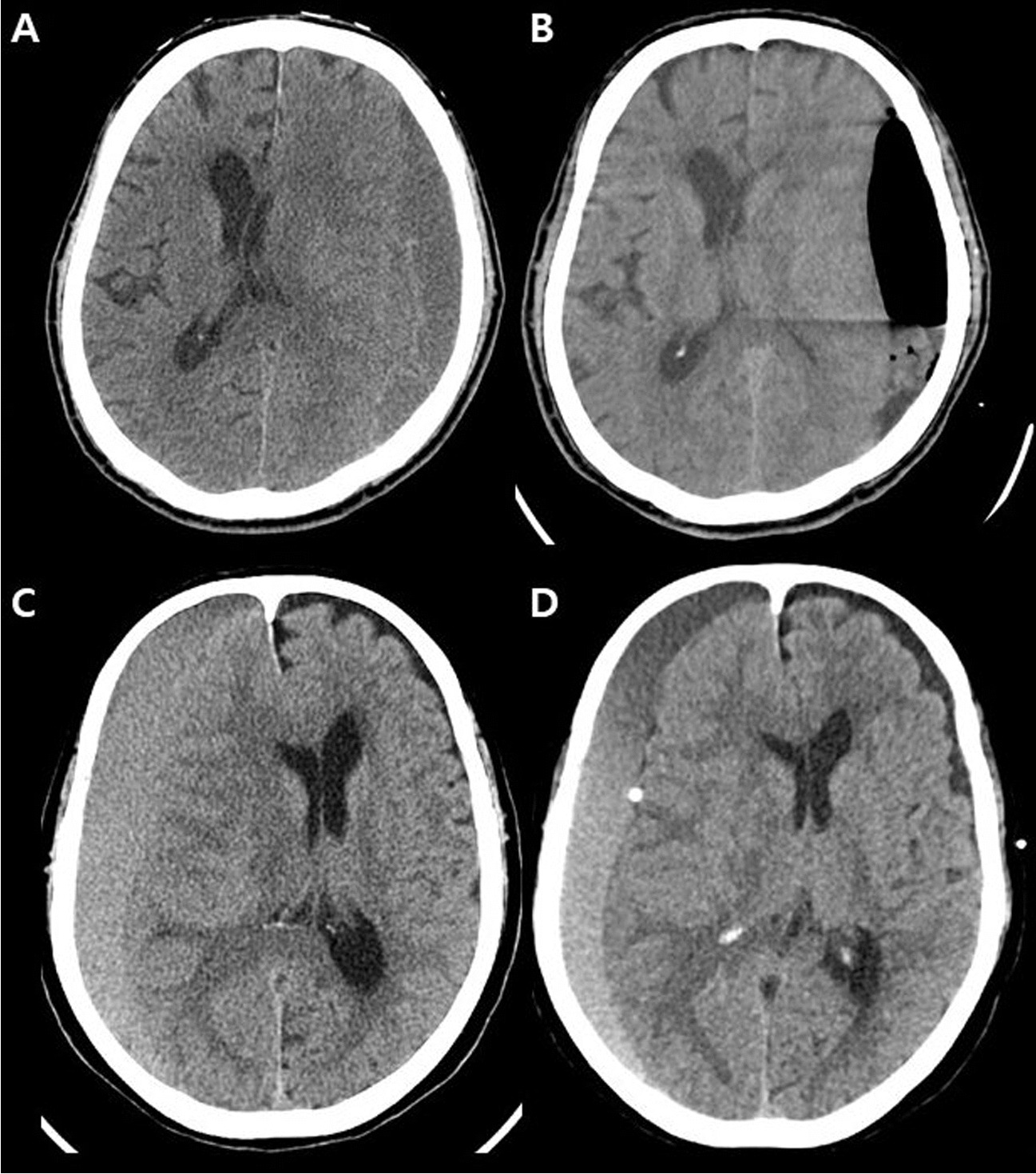 Comparative clinical outcomes of irrigation techniques in burr-hole craniostomy for chronic subdural hemorrhage: a multicenter cohort study