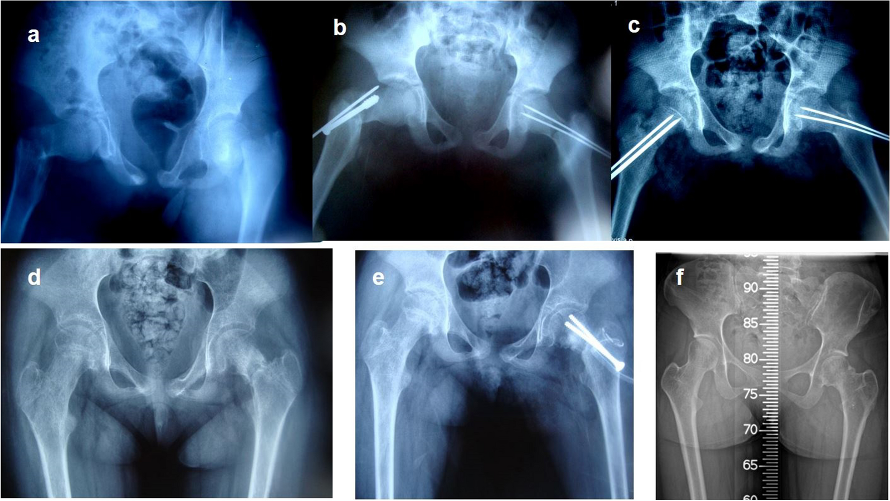 Analysis of influential factors on surgical outcomes in pediatric femur neck fractures: a single-institution retrospective study