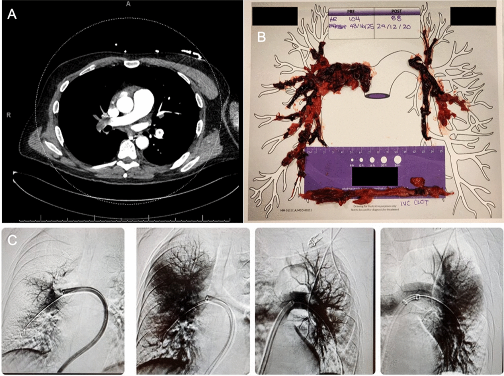 Transvenous catheter-directed embolectomy for pulmonary embolism